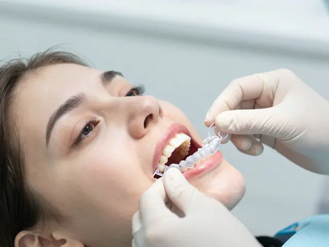 Co je opalescence a jak funguje bělení zubů tímto způsobem?