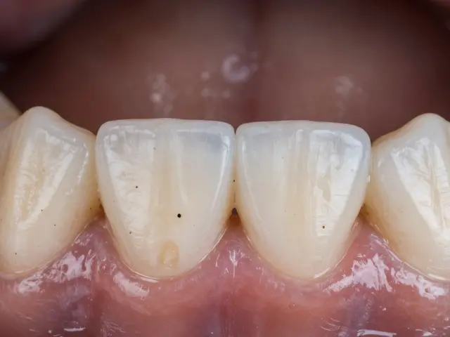 Jak se zbavit černých teček na zubech: příčiny a efektivní řešení