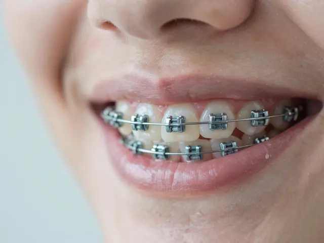 Jak se vyhnout zničeným zubům po rovnátkách: Kompletní průvodce prevencí